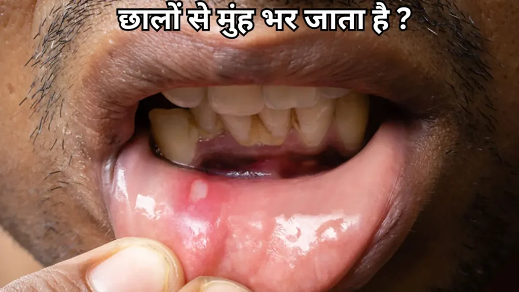 MOUTH ULCER